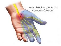 síndrome do túnel do carpo