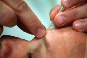 parkinson e acupuntura